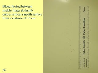 Flick 1: Blood flicked between  middle finger & thumb  onto a vertical smooth surface  from a distance of 15 cm 56 
