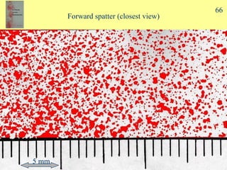 Forward spatter (closest view) 5 mm 66 