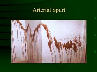 Arterial Spurt