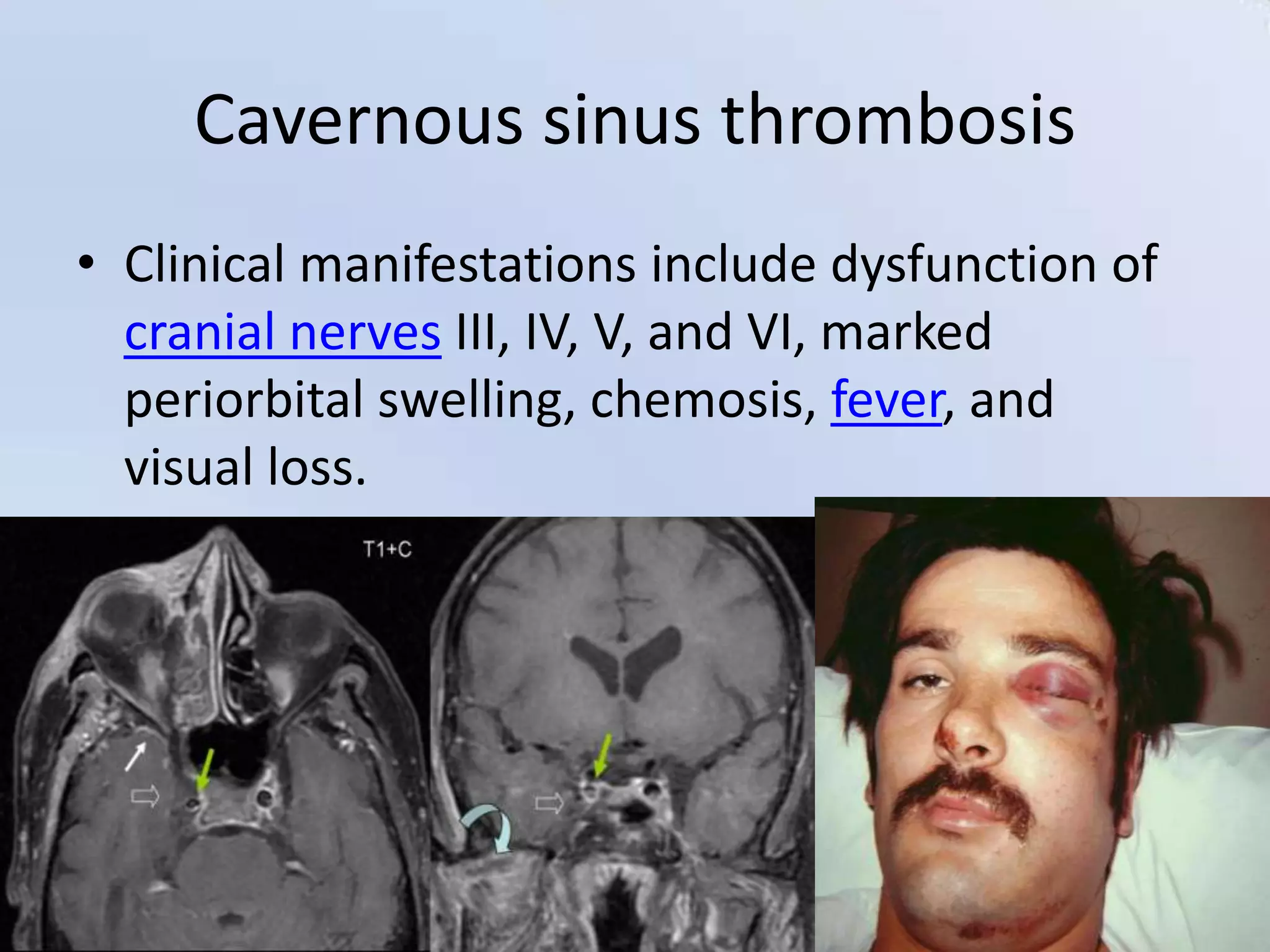 Cavernous sinus thrombosis
• Clinical manifestations include dysfunction of
cranial nerves III, IV, V, and VI, marked
periorbital swelling, chemosis, fever, and
visual loss.

1/7/2014

34

 