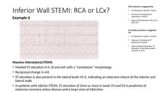 Blood Supply of SA and AV Nodes and Inferior Wall MI.pptx