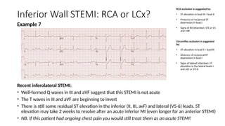 Avl Sign Blood Supply of SA and AV Nodes and Inferior Wall MI.pptx