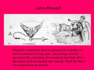 James Blundell Blundell’s transfusion devices included the impellor (A),  which consisted of a cup, tube , and syringe; and the  gravitator (B), consisting of a receptacle held high above the patient with an attached tube through which the blood  was injected into the patient. 