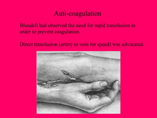 Anti-coagulation Blundell had observed the need for rapid transfusion in order to prevent coagulation. Direct transfusion (artery to vein for speed) was advocated. 