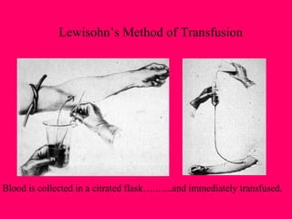 Lewisohn’s Method of Transfusion Blood is collected in a citrated flask….…...and immediately transfused. 
