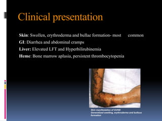 Clinical presentation
Skin: Swollen, erythroderma and bullae formation- most common
GI: Diarrhea and abdominal cramps
Liver: Elevated LFT and Hyperbilirubinemia
Heme: Bone marrow aplasia, persistent thrombocytopenia
Skin manifestation of GVHD
Generalized swelling, erythroderma and bullous
formation
 