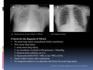 (a) Bilateral patchy alveolar infiltrate in TRALI (b) Complete resolution
a b
Criteria for the diagnosis of TRALI
• No acute lung injury immediately before transfusion
• New acute lung injury:
1. acute onset lung injury,
2. no circulatory overload or PA pressures <18mmHg,
3. bilateral pulm infiltrate on Cxr,
4. Hypoxemia:Pa02/FiO2 <300, or sat <90% on RA.
• Onset within 6 hours after transfusion
• No temporal relation to an alternate risk factor for acute lung injury
Popovsky TP et al TRALI; definition and review. Crit care Med 2005
 