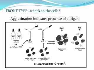 FRONT TYPE –what’s on the cells?
Agglutination indicates presence of antigen
 