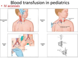Blood transfusion in pediatrics
• IV accesses
 