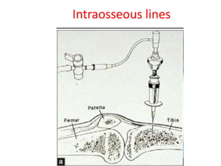 Intraosseous lines
 