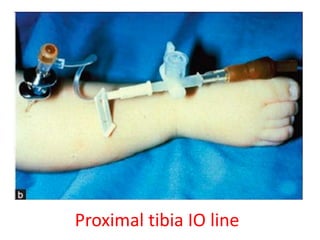 Proximal tibia IO line
 