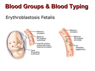 Blood Groups & Blood TypingBlood Groups & Blood Typing
Erythroblastosis Fetalis
 