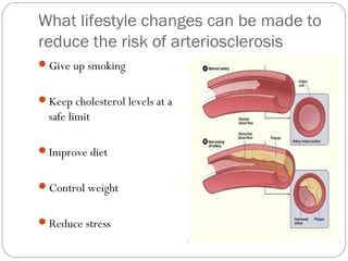 What lifestyle changes can be made to
reduce the risk of arteriosclerosis
Give up smoking
Keep cholesterol levels at a

safe limit
Improve diet
Control weight
Reduce stress

 