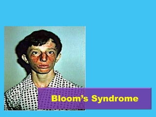 Bloom’s Syndrome
 