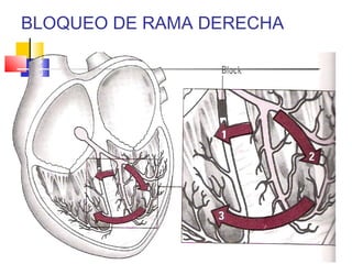 BLOQUEO DE RAMA DERECHA
 