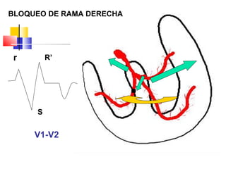 r
S
R’
V1-V2
BLOQUEO DE RAMA DERECHA
 