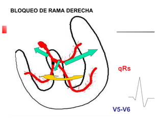 BLOQUEO DE RAMA DERECHA
V5-V6
qRs
 