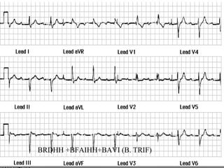 BRDHH +BFAIHH+BAVI (B. TRIF)
 