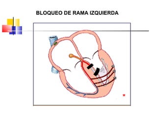 BLOQUEO DE RAMA IZQUIERDA
 
