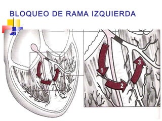 BLOQUEO DE RAMA IZQUIERDA
 