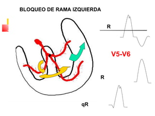 BLOQUEO DE RAMA IZQUIERDA
V5-V6
R
R
qR
 