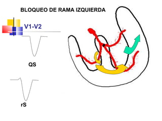 BLOQUEO DE RAMA IZQUIERDA
QS
V1-V2
rS
 