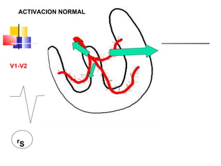 r
S
V1-V2
ACTIVACION NORMAL
 