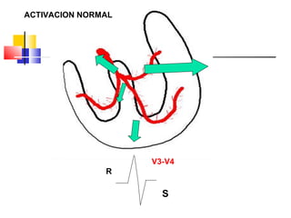 R
V3-V4
S
ACTIVACION NORMAL
 