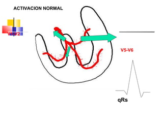 qRs
V1-V2
V5-V6
ACTIVACION NORMAL
 