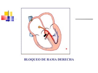 BLOQUEO DE RAMA DERECHA
 