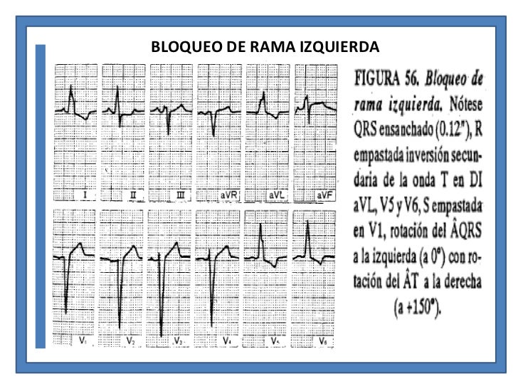 BLOQUEO DEL HAZ DE HIS (BLOQUEO DE RAMA)