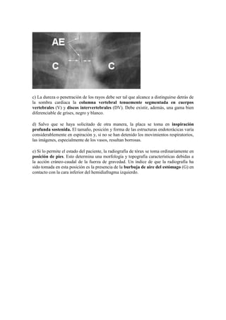 c) La dureza o penetración de los rayos debe ser tal que alcance a distinguirse detrás de
la sombra cardiaca la columna vertebral tenuemente segmentada en cuerpos
vertebrales (V) y discos intervertebrales (DV). Debe existir, además, una gama bien
diferenciable de grises, negro y blanco.

d) Salvo que se haya solicitado de otra manera, la placa se toma en inspiración
profunda sostenida. El tamaño, posición y forma de las estructuras endotorácicas varía
considerablemente en espiración y, si no se han detenido los movimientos respiratorios,
las imágenes, especialmente de los vasos, resultan borrosas.

e) Si lo permite el estado del paciente, la radiografía de tórax se toma ordinariamente en
posición de pies. Esto determina una morfología y topografía características debidas a
la acción cráneo-caudal de la fuerza de gravedad. Un índice de que la radiografía ha
sido tomada en esta posición es la presencia de la burbuja de aire del estómago (G) en
contacto con la cara inferior del hemidiafragma izquierdo.
 