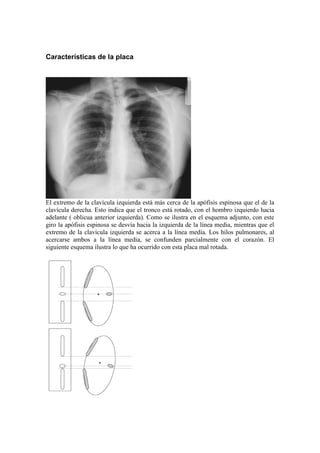 Características de la placa




El extremo de la clavícula izquierda está más cerca de la apófisis espinosa que el de la
clavícula derecha. Esto indica que el tronco está rotado, con el hombro izquierdo hacia
adelante ( oblicua anterior izquierda). Como se ilustra en el esquema adjunto, con este
giro la apófisis espinosa se desvía hacia la izquierda de la línea media, mientras que el
extremo de la clavícula izquierda se acerca a la línea media. Los hilos pulmonares, al
acercarse ambos a la línea media, se confunden parcialmente con el corazón. El
siguiente esquema ilustra lo que ha ocurrido con esta placa mal rotada.
 