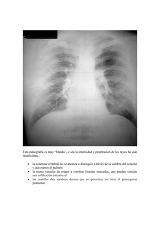 Esta radiografía es muy “blanda”, o sea la intensidad y penetración de los rayos ha sido
insuficiente.:

       la columna vertebral no se alcanza a distinguir a través de la sombra del corazón
       y aún menos el pulmón
       la trama vascular da origen a sombras lineales marcadas, que pueden simular
       una infiltración intersticial.
       las costillas dan sombras densas que no permiten ver bien el parénquima
       pulmonar.
 
