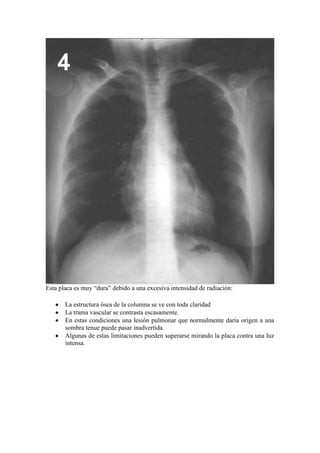 Esta placa es muy “dura” debido a una excesiva intensidad de radiación:

       La estructura ósea de la columna se ve con toda claridad
       La trama vascular se contrasta escasamente.
       En estas condiciones una lesión pulmonar que normalmente daría origen a una
       sombra tenue puede pasar inadvertida.
       Algunas de estas limitaciones pueden superarse mirando la placa contra una luz
       intensa.
 