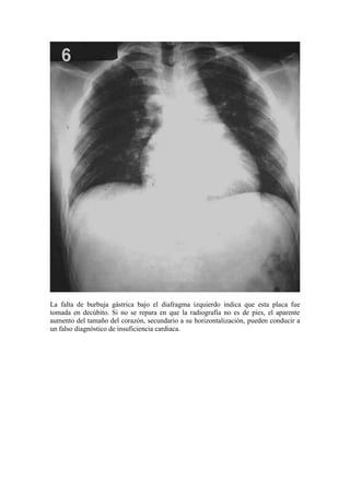 La falta de burbuja gástrica bajo el diafragma izquierdo indica que esta placa fue
tomada en decúbito. Si no se repara en que la radiografía no es de pies, el aparente
aumento del tamaño del corazón, secundario a su horizontalización, pueden conducir a
un falso diagnóstico de insuficiencia cardiaca.
 