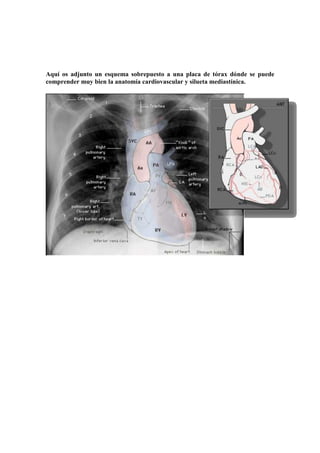 Aquí os adjunto un esquema sobrepuesto a una placa de tórax dónde se puede
comprender muy bien la anatomía cardiovascular y silueta mediastínica.
 