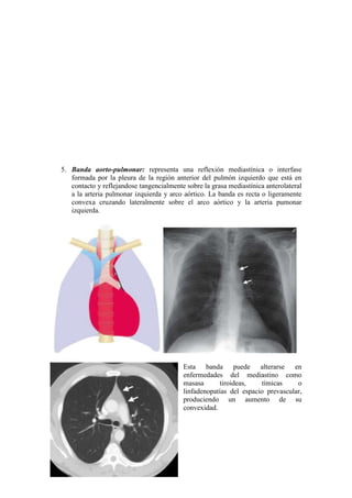 5. Banda aorto-pulmonar: representa una reflexión mediastínica o interfase
   formada por la pleura de la región anterior del pulmón izquierdo que está en
   contacto y reflejandose tangencialmente sobre la grasa mediastínica anterolateral
   a la arteria pulmonar izquierda y arco aórtico. La banda es recta o ligeramente
   convexa cruzando lateralmente sobre el arco aórtico y la arteria pumonar
   izquierda.




                                          Esta banda puede alterarse en
                                          enfermedades del mediastino como
                                          masasa      tiroideas,    tímicas     o
                                          linfadenopatías del espacio prevascular,
                                          produciendo un aumento de su
                                          convexidad.
 