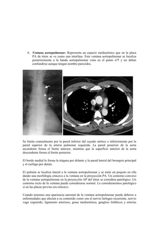 6. Ventana aortopulmonar: Representa un espacio mediastínico que en la placa
      PA de tórax se ve como una interfase. Esta ventana aortopulmonar se localiza
      posteriormente a la banda aortopulmonar vista en el punto nº5 y no deben
      confundirse aunque tengan nombre parecidos.




Se limita cranealmente por la pared inferior del cayado aórtico e inferiormente por la
pared superior de la arteria pulmonar izquierda. La pared posterior de la aorta
ascendente forma el límite anterior, mientras que la superficie anterior de la aorta
descendente forma el límite posterior.

El borde medial lo forma la tráquea por delante y la pared lateral del bronquio principal
y el esófago por detrás.

El pulmón se localiza lateral a la ventana aortopulmonar y se mete un poquito en ella
dando una morfología cóncava a la ventana en la proyección PA. Un contorno convexo
de la ventana aortopulmonar en la proyección AP del tórax se considera patológico. Un
contorno recto de la ventana puede considerarse normal. Lo consideraremos patológico
si en las placas previas era cóncavo.

Cuando tenemos una apariencia anormal de la ventana aortopulmonar puede deberse a
enfermedades que afectan a su contenido como son el nervio laríngeo recurrente, nervio
vago izquierdo, ligamento arterioso, grasa mediastínica, ganglios linfáticos y arterias
 