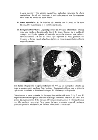 la cava superior y los troncos supraaórticos delimitan claramente la silueta
       mediastínica. En el lado izquierdo, la subclavia presenta una línea cóncava
       hacia fuera, por encima del botón aórtico.

   12. Línea paraaórtica: Es la interfase del pulmón con la pared de la aorta
       descendente. Digamos que es el contorno de la aorta.

   13. Bronquio intermediario: La pared posterior del bronquio intermediario aparece
       como una banda en la radiografía lateral del tórax. Después de la salida del
       bronquio del lóbulo superior el bronquio intermedio continua descendiendo
       aproximadamente 3-4 cm. La banda que repreenta la pared posterior del
       bronquio se horma cuando el pulmón del receso pleuroacigoesofágico delimita
       su pared posterior.




Esta banda está presenta en aproximadamente 90-95% de las radiografías laterales de
tórax y aparece como una línea fina, vertical, y ligeramente oblicua que se proyecta
típicamente a través de la licencia del bronquio del lóbulo superior izquierdo.

Normalmente la pared posterior del bronquio intermedio mide entre 0,5 y 3 mm. El
engrosamiento anormal puede tener una morfología lobulada o de banda. La causa más
común de engrosamiento de las paredes del bronquio intermedio es el edema pulmonar
por fallo cardiaco congestivo. Otras causas incluyen neoplasias como el carcinoma
pulmonar primario, adenopatías por linfoma, tuberculosis o sarcoidosis.
 