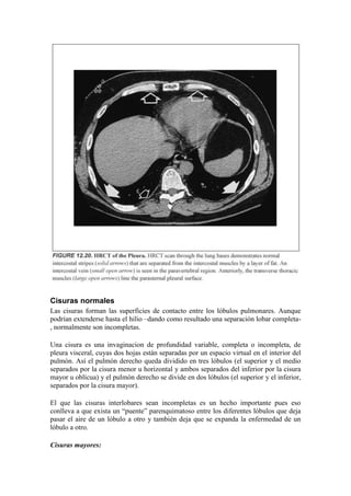 Cisuras normales
Las cisuras forman las superficies de contacto entre los lóbulos pulmonares. Aunque
podrían extenderse hasta el hilio –dando como resultado una separación lobar completa-
, normalmente son incompletas.

Una cisura es una invaginacion de profundidad variable, completa o incompleta, de
pleura visceral, cuyas dos hojas están separadas por un espacio virtual en el interior del
pulmón. Así el pulmón derecho queda dividido en tres lóbulos (el superior y el medio
separados por la cisura menor u horizontal y ambos separados del inferior por la cisura
mayor u oblícua) y el pulmón derecho se divide en dos lóbulos (el superior y el inferior,
separados por la cisura mayor).

El que las cisuras interlobares sean incompletas es un hecho importante pues eso
conlleva a que exista un “puente” parenquimatoso entre los diferentes lóbulos que deja
pasar el aire de un lóbulo a otro y también deja que se expanda la enfermedad de un
lóbulo a otro.

Cisuras mayores:
 