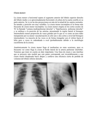 Cisura menor:

La cisura menor u horizontal separa el segmento anterior del lóbulo superior derecho
del lóbulo medio y es aproximadamente horizontal a la altura de la cuarta costilla en su
parte anterior. Se ve en las dos proyecciones en más de la mitad de los sujetos normales.
Su tamaño y posición son muy variables. La cisura menor incompleta es la forma más
frecuente de cisura menor incompleta. La cisura menor origina en los cortes axiales de
TC la llamada “ventana mediopulmonar derecha” o “hiperlucencia pulmonar derecha”
y se atribuye a la posición de las arterias, presentando la región lateral al bronquio
intermediario menor proporción de vasos grandes por lo que se ve como un área radio
transparente por su menor vascularización en sólo uno o dos cortes a nivel del bronquio
intermediario. La mayoría de las veces es de forma triangular con el vértice hacia el
hilio pero a veces es redondeada u oval (probablemente debido a la morfología
cuculiforme de la cisura).

Anatómicamente la cisura menor llega al mediastino en raras ocasiones, pero es
frecuente ver como llega la cisura al borde lateral de la arteria pulmonar interlobar.
Tenemos que tener en cuenta un dato importante: Una línea de cisura o una interfase
que se proyecte más medial que este punto corresponde casi invariablemente a una
cisura menor desplazada hacia abajao y conlleva una eficencia cierta de perdida de
volumen del lóbulo inferior derecho.
 