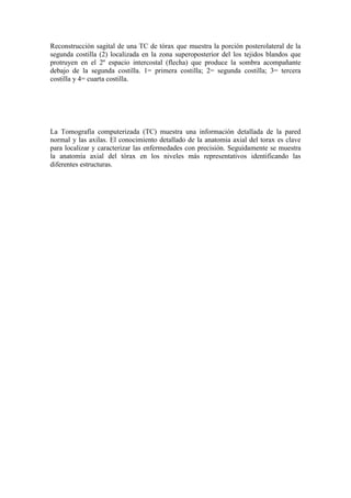 Reconstrucción sagital de una TC de tórax que muestra la porción posterolateral de la
segunda costilla (2) localizada en la zona superoposterior del los tejidos blandos que
protruyen en el 2º espacio intercostal (flecha) que produce la sombra acompañante
debajo de la segunda costilla. 1= primera costilla; 2= segunda costilla; 3= tercera
costilla y 4= cuarta costilla.




La Tomografía computerizada (TC) muestra una información detallada de la pared
normal y las axilas. El conocimiento detallado de la anatomia axial del torax es clave
para localizar y caracterizar las enfermedades con precisión. Seguidamente se muestra
la anatomía axial del tórax en los niveles más representativos identificando las
diferentes estructuras.
 