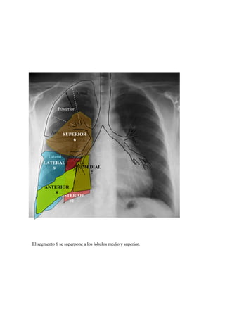 Apical


              Posterior

                          3 1
                   2
          Anterior
                SUPERIOR
                   Bronquio del
                      6
                   Lóbulo Medio


                  4
        Lateral
                5
      LATERAL
          9                     MEDIAL
                                  7
                  Medial

      ANTERIOR
         8
           POSTERIOR
               10




El segmento 6 se superpone a los lóbulos medio y superior.
 