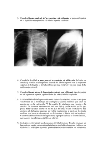 5. Cuando el borde izquierdo del arco aórtico está obliterado la lesión se localiza
   en el segmento apicoposterior del lóbulo superior izquierdo




6. Cuando la densidad se superpone al arco aórtico sin obliterarlo, la lesión es
   anterior y se sitúa en el segmento anterior del lóbulo superior o en el segmento
   superior de la língula. O por el contrario es muy posterior y se sitúa cerca de la
   unión costovertebral.

7. Cuando el borde lateral de la aorta descendente está obliterado hay afectación
   de los segmentos superior y posterobasal del lóbulo inferior izquierdo

8. La borrosidad del diafragma derecho no tiene valor absoluto ya que existe gran
   variabilidad en la morfología del diafragma y además tenemos que tener en
   cuenta que en la radiografía PA la porción del diafragma que vemos es la
   anterior. La posterior habitualmente está más baja y queda oculta, por lo que
   puede haber lesiones ocultas en la Rx. PA de tórax en esa localización. Sin
   embargo el diafragma izquierdo es visible parcialmente a través de la silueta
   cardiaca y se borra ocasionalmente por lesiones en el lóbulo inferior izquierdo.
   Cuando la obliteración del diafragma tiene lugar por fuera de la silueta cardiaca,
   casi siempre hay afectación del lóbulo inferior.

9. En la proyección lateral, las alteraciones del lóbulo inferior derecho producen un
   borramiento parcial o completo del diafragma que habitualmente es visible en su
   totalidad. El diafragma izquierdo generalmente solo es visible en sus dos tercios
 