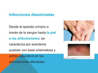 CUADRO 26-3
Infecciones diseminadas
Desde el aparato urinario a
través de la sangre hasta la piel
o las articulaciones; se
caracteriza por exantema
pustular con base eritematosa y
artritis supurativa en las
articulaciones afectadas.
 