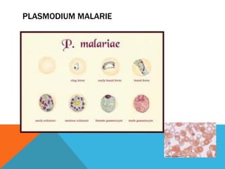 PLASMODIUM MALARIE
 