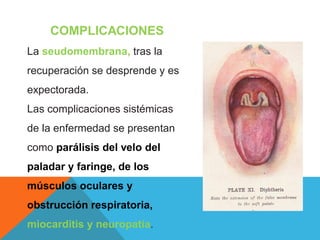 COMPLICACIONES
La seudomembrana, tras la
recuperación se desprende y es
expectorada.
Las complicaciones sistémicas
de la enfermedad se presentan
como parálisis del velo del
paladar y faringe, de los
músculos oculares y
obstrucción respiratoria,
miocarditis y neuropatía.
 