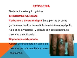 PATOGENIA
Bacteria invasiva y toxigénica.
SINDROMES CLÍNICOS
Carbunco o úlcera maligna En la piel las esporas
germinan a bacilos, se multiplican e inician una pápula,
12 a 36 h, a vesícula, y pústula con costra negra, se
disemina a septicemia.
Septicemia carbuncosa
A partir de una úlcera en la piel se
disemina por vía hemática y causa
septicemia,
 