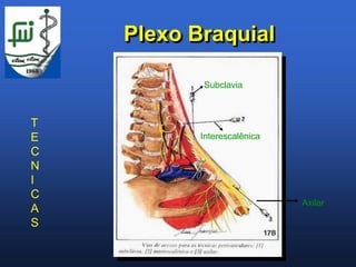 Plexo Braquial

           Subclavia



T
E          Interescalênica
C
N
I
C
                             Axilar
A
S
 